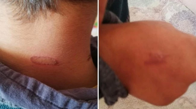 Öğrencilerini kızgın demir ile dağladığı iddia edilen sözleşmeli öğretmen açığa alındı