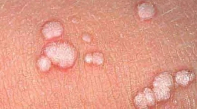 Erkekte ve Kadında HPV virüsü nedir, Nasıl bulaşır, Human HPV (Human papilloma virus) Tedavisi